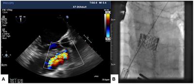 Hybrid Surgery Options for Complex Clinical Scenarios in Adult Patients with Congenital Heart Disease: Three Case Reports